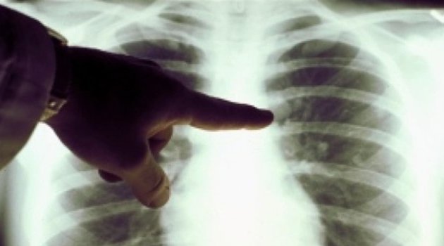 Tuberculose : 1,4 million de malades privés des soins nécessaires pendant la première année de la Covid-19