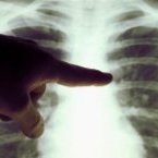 Tuberculose : 1,4 million de malades privés des soins nécessaires pendant la première année de la Covid-19