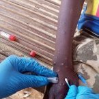 Mpox en Afrique : les enfants particulièrement menacés par la nouvelle variante